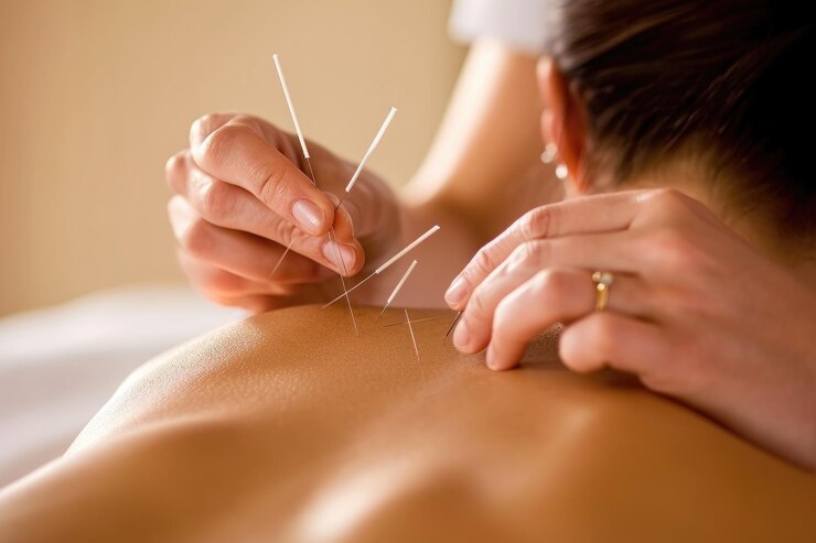 Acupuncture Doctor Chennai | Natural Healing & Pain Relief in Chennai